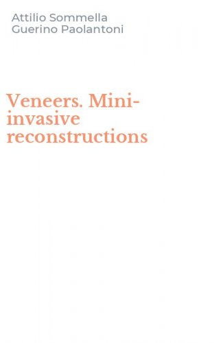 Veneers. Mini-invasive reconstructions